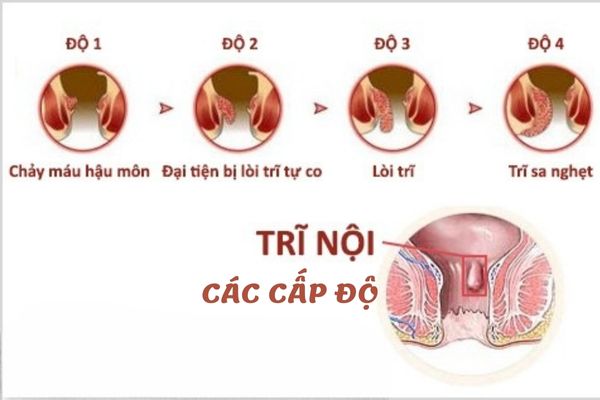 Dấu hiệu nhận biết các cấp độ bệnh trĩ nội