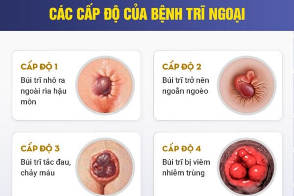 Biểu hiện của bệnh trĩ ngoại