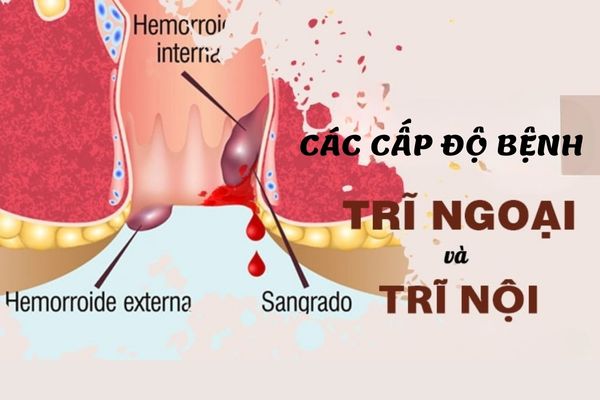 Cách nhận biết các cấp độ bệnh trĩ có thể bạn chưa biết