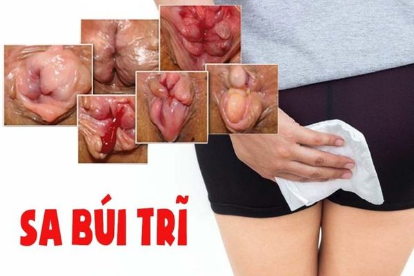 Sa búi trĩ là dấu hiệu bệnh trĩ đã tiến triển nghiêm trọng