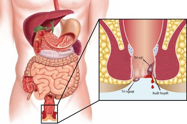 Trĩ là bệnh lý khá phổ biến hiện nay