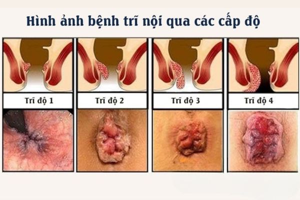 Bệnh trĩ nội trải qua 4 cấp độ bệnh lý