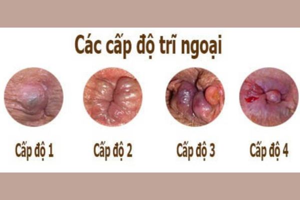 Bệnh trĩ ngoại có nhiều biểu hiện nhận biết hơn trĩ nội