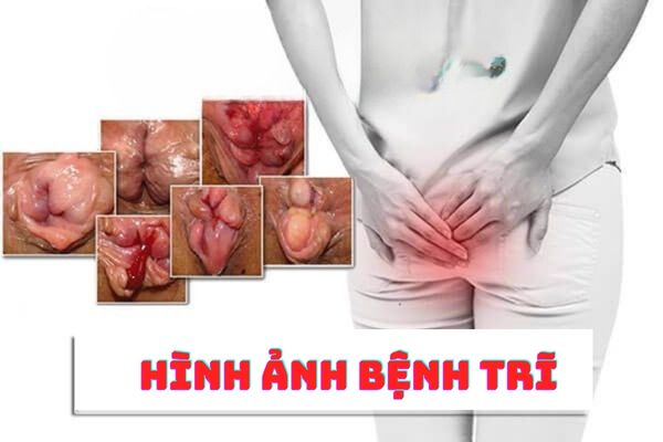 Hình ảnh bệnh trĩ nội và ngoại – Dấu hiệu phân biệt rõ ràng