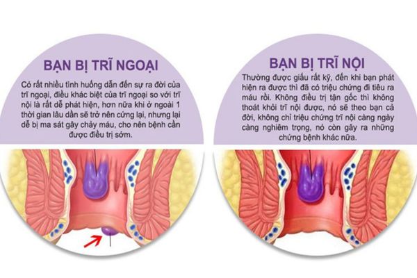 Trĩ nội và trĩ ngoại là 2 loại bệnh trĩ phổ biến nhất
