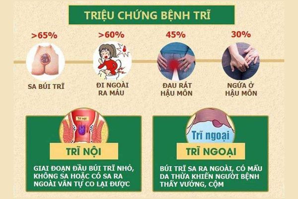 Triệu chứng nhận biết bệnh trĩ nội và trĩ ngoại