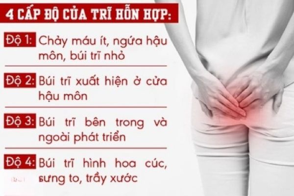 Dấu hiệu nhận biết bệnh trĩ hỗn hợp