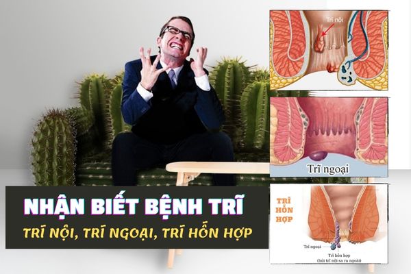Nhận biết bệnh trĩ kịp thời: Trĩ nội, trĩ ngoại và trĩ hỗn hợp
