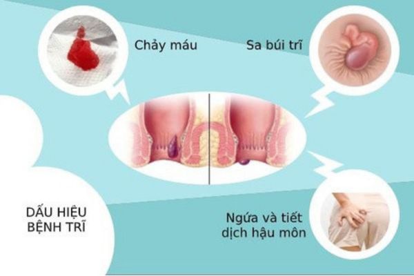 Người bị bệnh trĩ sẽ xuất hiện các dấu hiệu bệnh lý đặc trưng