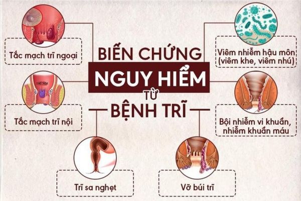 Bệnh trĩ gây ra nhiều ảnh hưởng nghiêm trọng đến sức khỏe