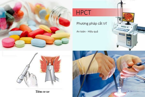 Phương pháp điều trị bệnh trĩ hiệu quả