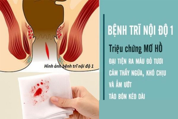 Dấu hiệu nhận biết trĩ nội cấp độ 1