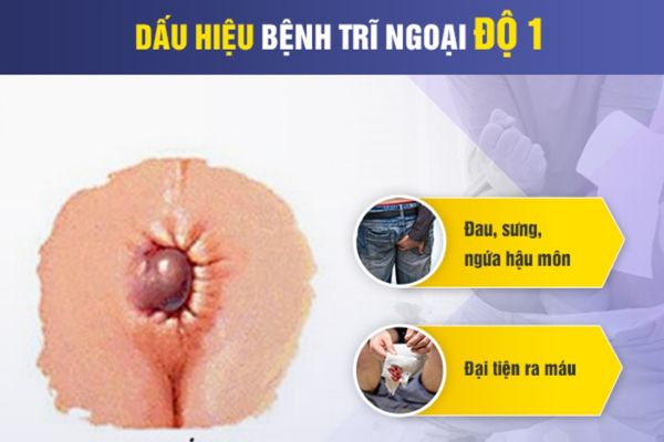 Triệu chứng nhận biết trĩ ngoại cấp độ 1