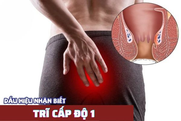 Trĩ cấp độ 1 – Dấu hiệu nhận biết và cách điều trị hiệu quả