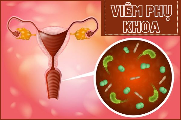 Các thông tin cần biết về viêm phụ khoa