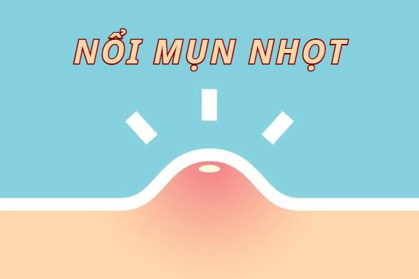 Cẩn thận với hiện tượng nổi mụn nhọt
