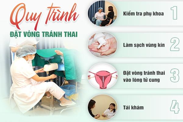 Quy trình đặt vòng tránh thai đúng chuẩn khoa học tại Quy Nhơn