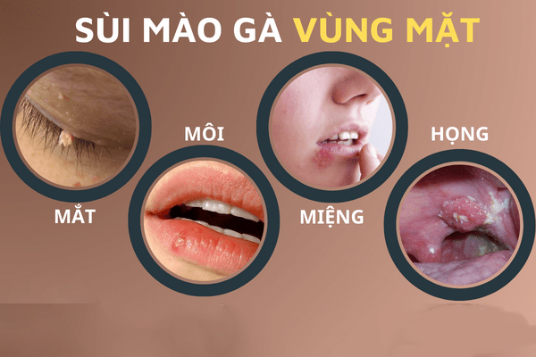 Xac-dinh-hinh-anh-sui-mao-ga-o-cac-vi-tri-tren-co-the-3