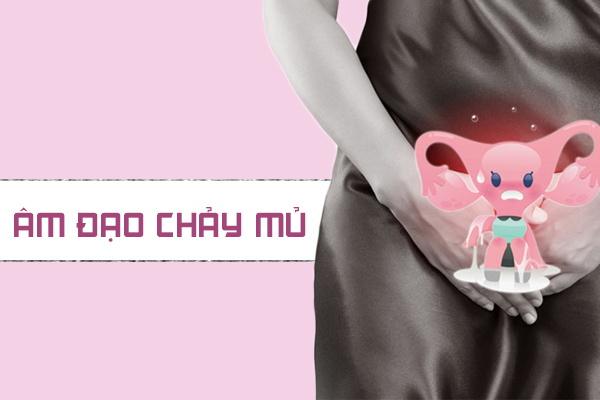 Âm đạo chảy mủ: Nguyên nhân và cách điều trị