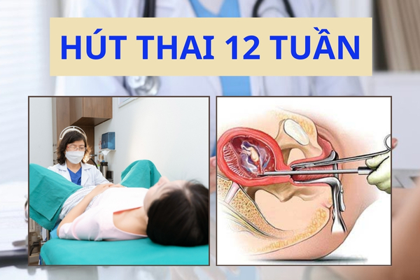 Phương pháp hút thai 12 tuần là gì? Địa chỉ phá thai an toàn tại Quy Nhơn