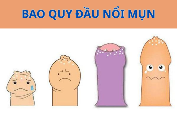Bao quy đầu nổi mụn là dấu hiệu bệnh gì?
